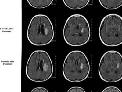 Imaging shows effect of investigational radiation necrosis treatment