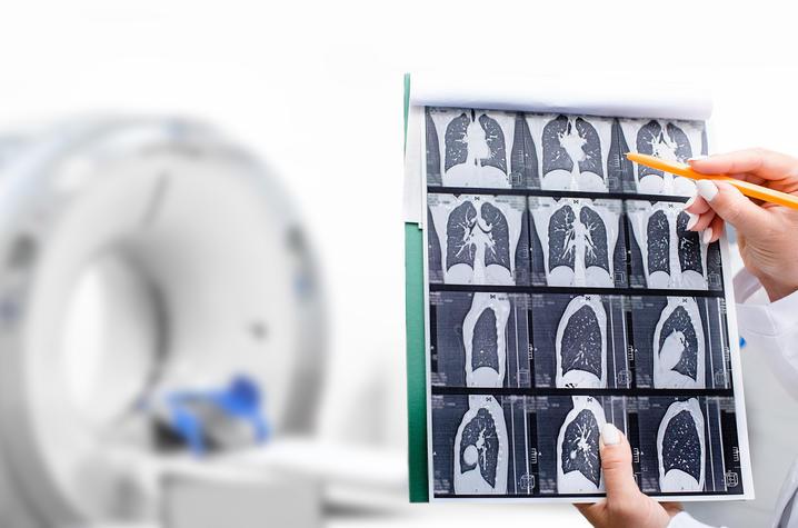 In the front left of the frame we see chest xrays indicating possible lung cancer. Hands intruding from outside the frame hold the films and point to them with a pencil. 