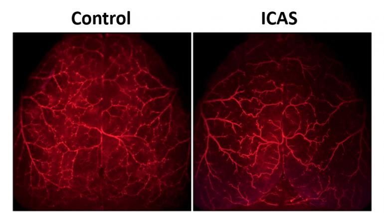 Side by side images of two blood vessel brain scans, red fields with blood vessels illuminated. The right side shows a normal mouse's brain; the left shows a mouse brain with internal carotid artery stenosis (ICAS) from implanted mircrocoils. The ICAS brain has fewer blood vessels and less branching. 