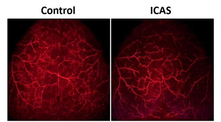 Side by side images of two blood vessel brain scans, red fields with blood vessels illuminated. The right side shows a normal mouse's brain; the left shows a mouse brain with internal carotid artery stenosis (ICAS) from implanted mircrocoils. The ICAS brain has fewer blood vessels and less branching. 